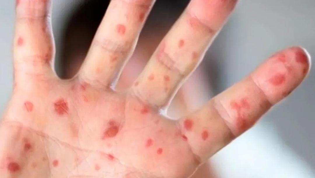 Sarampión en Jalisco: Se ubica entre los estados con mayor casos