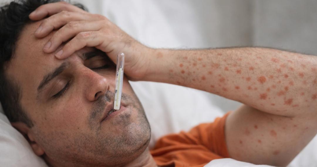 Sarampión en México: Razones por las que no se anticipa una crisis como la del COVID-19 