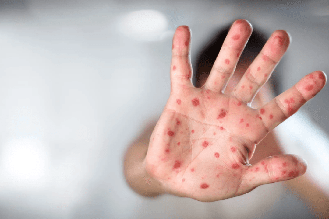 Sarampión en Jalisco: Suman 27 hospitalizados por brote activo