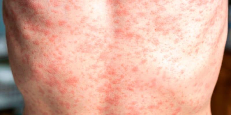 Sarampión en México: Aumenta a 33 muertes por casos